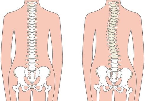 Low back pain due to spinal deformity such as scoliosis