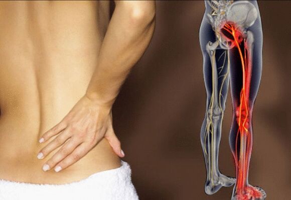 Sciatica