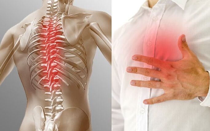 Chest osteochondrosis and chest pain
