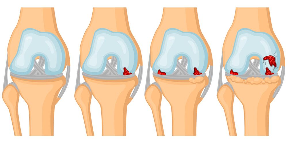 The degree of development of joint arthrosis